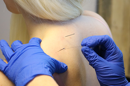 Woman receiving medical acupuncture treatment